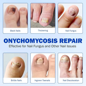 Night time Renewal Fungal Nail Patches