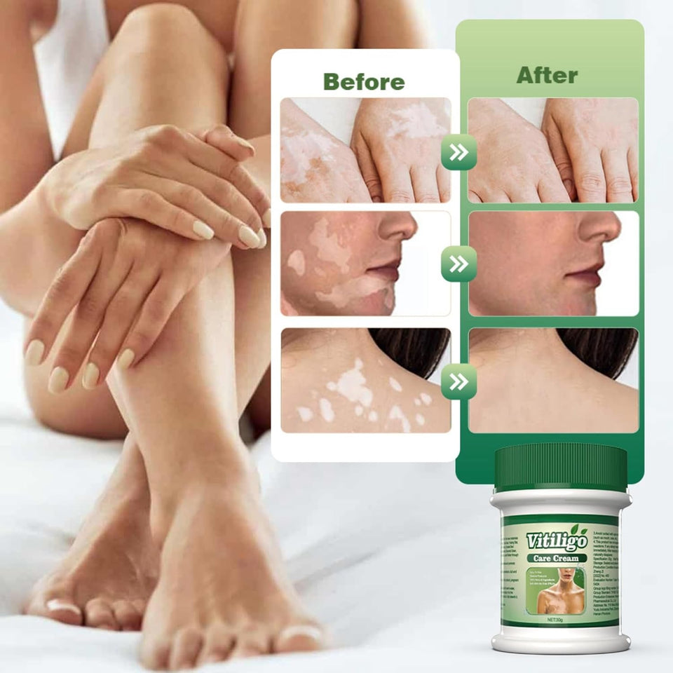 Intensive Skin Repair Vitiligo Care Cream