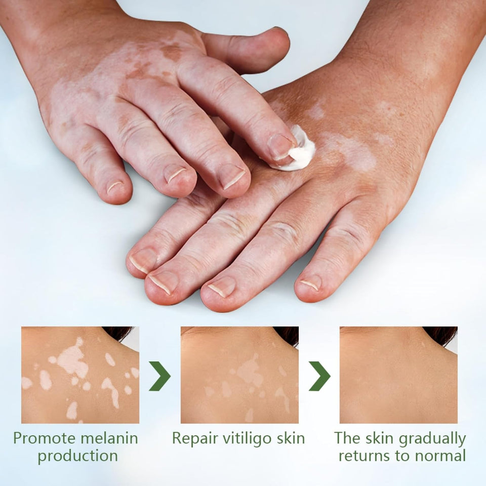 Intensive Skin Repair Vitiligo Care Cream
