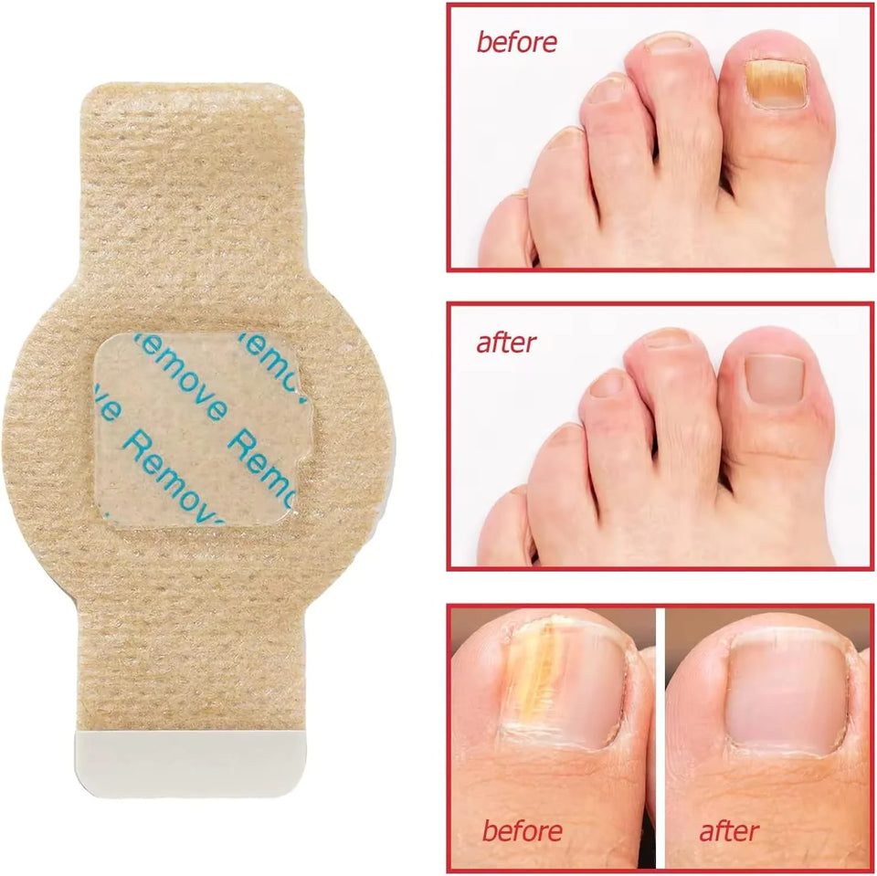 Night time Renewal Fungal Nail Patches