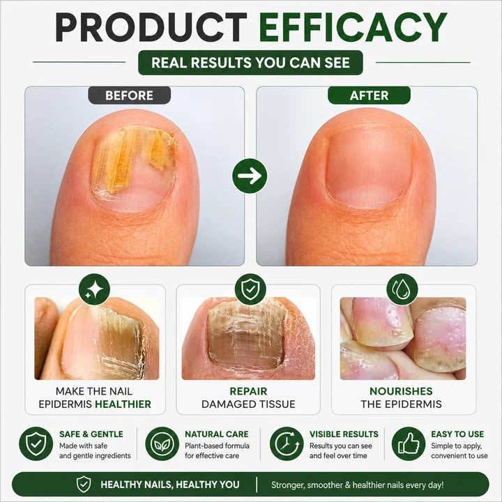 Herbal Nail Fungus Treatment Oil