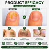 Herbal Nail Fungus Treatment Oil