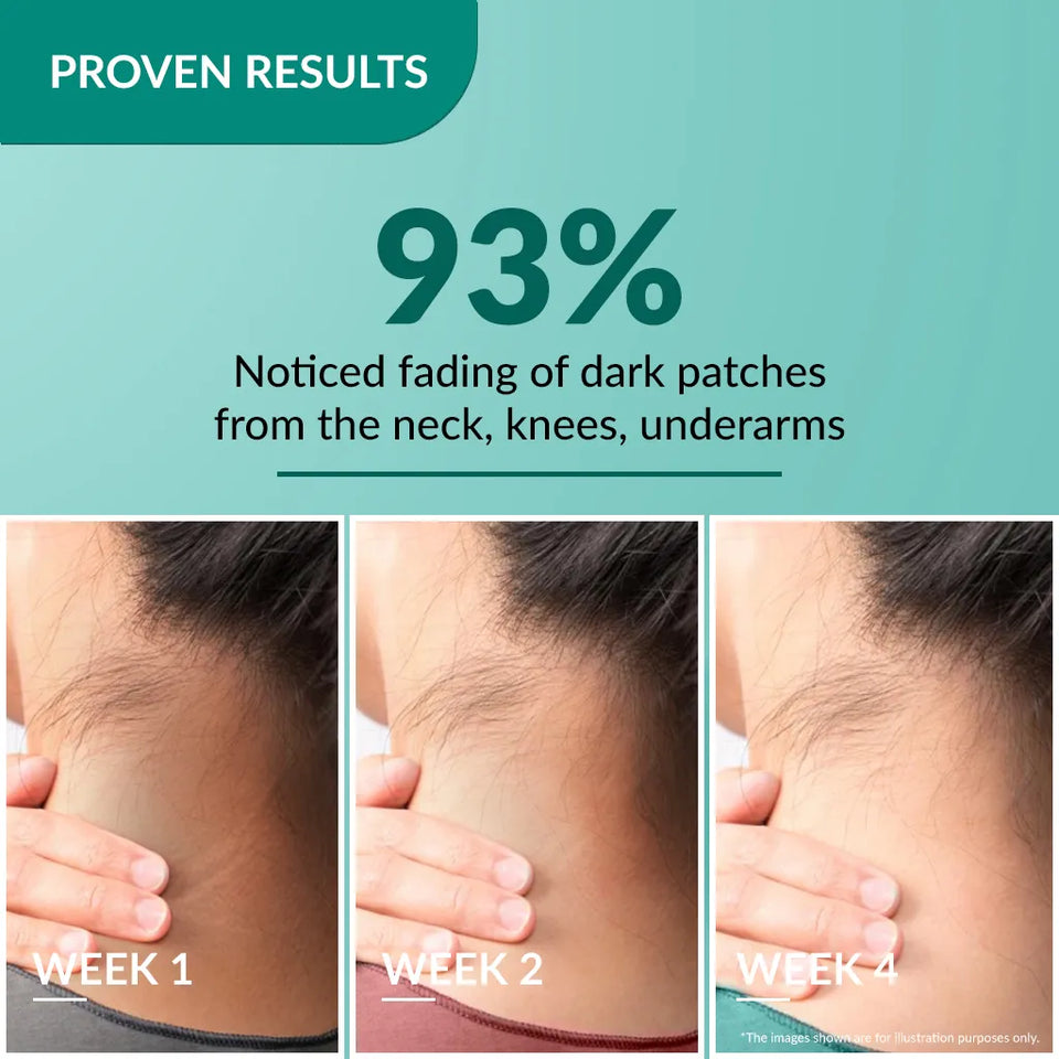 Nigrifix Cream A patented solution to treat hyperpigmentation